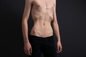 Anorexia en adolescentes: causas y síntomas